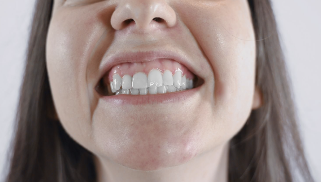 paciente observando una retracción de encías en los dientes delanteros
