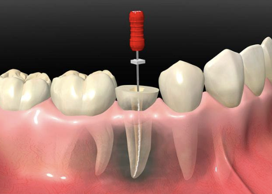 Tratamiento de endodoncia