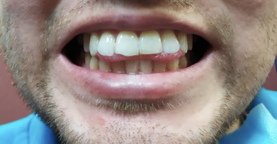 dientes torcidos